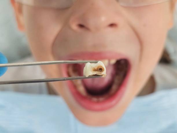 Best Emergency Wisdom Teeth Removal in Rafter J Ranch, WY
